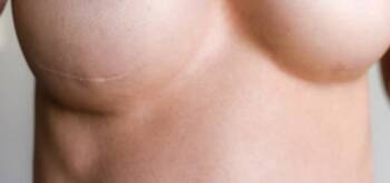 Combien de séances pour un traitement laser des cicatrices ? | Centre Laserio | Paris 8