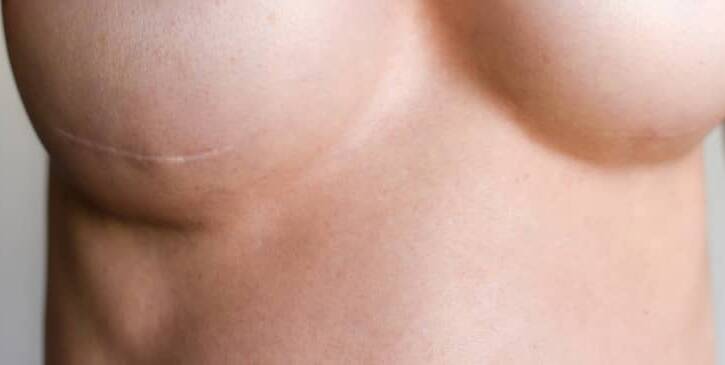 Combien de séances pour un traitement laser des cicatrices ? | Centre Laserio | Paris 8