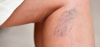 J’ai des varices : est-ce dangereux ? | Centre Laserio | Paris 8