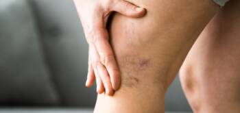 Les varices disparaissent-elles naturellement ? | Centre Laserio | Paris 8