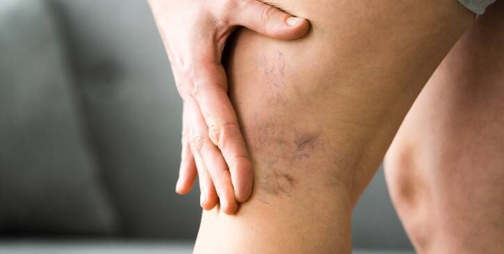 Les varices disparaissent-elles naturellement ? | Centre Laserio | Paris 8